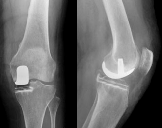 صورة بالأشعة لاستبدال الركبة ذات الحجيرة الواحدة.